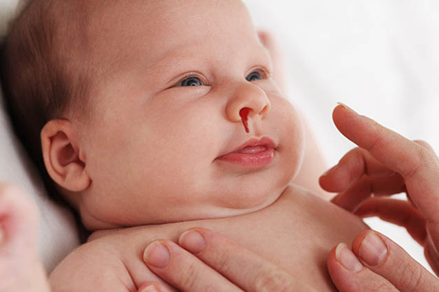 Кровотечение из носа у ребенка